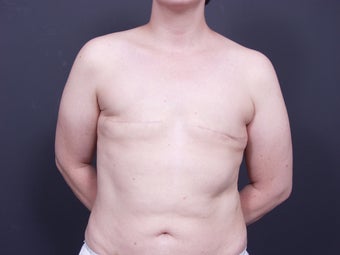 37 Year Old Female for Breast Reconstruction before 643165