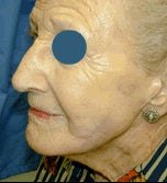 Mohs skin cancer surgery with reconstruction on the cheek after 84501