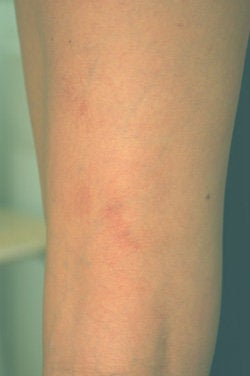 Laser Treatments for Spider Veins after 104206