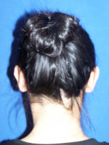 Ear Surgery (otoplasty) before 130068