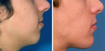 Chin Implant before 642995