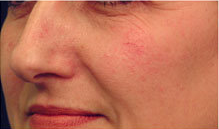 Laser Vein Treatment before 349200