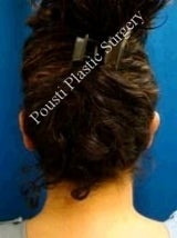 Ear Surgery (Otoplasty) after 584556