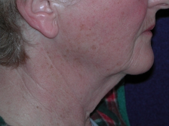 Necklift 208439