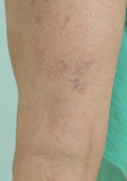 Laser Treatments for Spider Veins before 104206