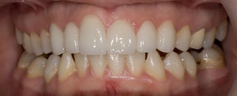 porcelain veneers 363976