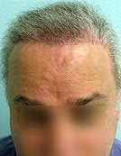 FUE – BHT Using Beard and Body Hair Only 2,000 graft repair using Stomach, Arm, and Leg donor hair after 196033