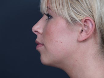 Chin Implant before 462482