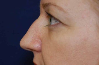 Non-Surgical Rhinoplasty before 513494
