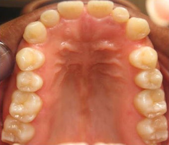 Invisalign before 436971