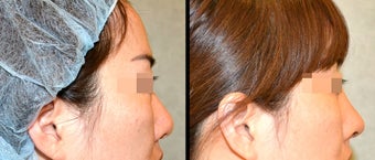 Rhinoplasty before 650736