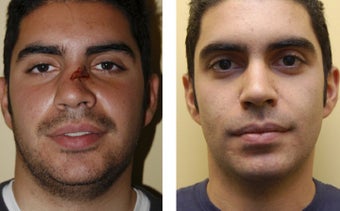 Revision rhinoplasty before 359001