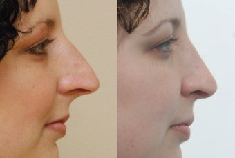 Rhinoplasty before 227863