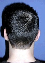 Ear Surgery (Otoplasty) 357650