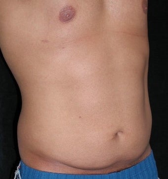 Male tummy Tuck, Flank Liposuction 578199