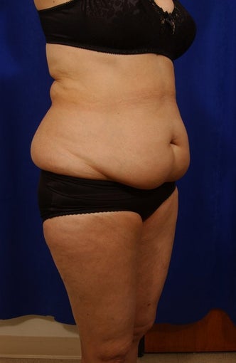 Abdominoplasty with liposculpture of abs and flanks before 82412