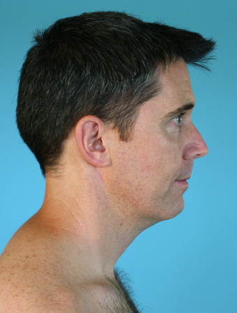 Neck Lift after 229647