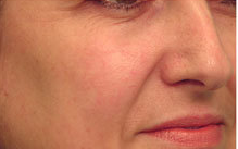 Laser Vein Treatment 349200