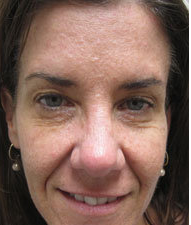 Botox after 387834