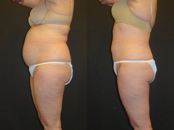 SmartLipo before 96273