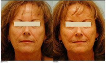 Mole Removal before 138532