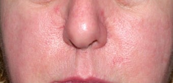 Vbeam for rosacea 374537