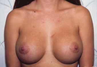 Breast Augmentation after 266791