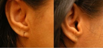 Torn Earlobe Repair before 138535