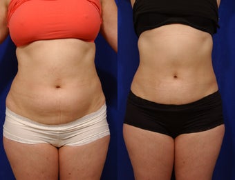Liposculpture on abdomen, flanks and thighs before 59036