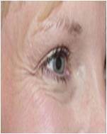 Botox before 396256