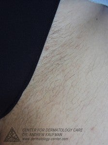 Laser Hair Removal to Bikini Area before 315169