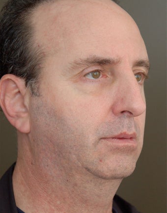 Chin Augementation before 273276