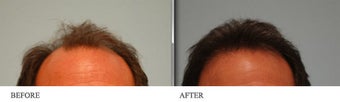 Hair Transplant before 458713