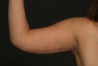 Arm Lift after 289481