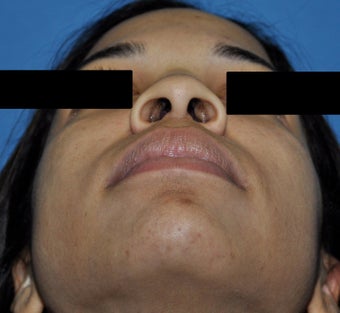 African American Rhinoplasty before 364921