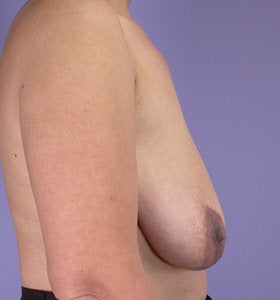 Breast Reduction before 285315