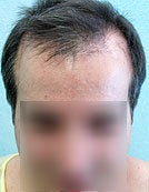 FUE – BHT by SFET Using Only Nape, Head and Body Hair before 196036