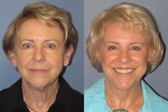 Lite Lift™, brow lift, liposuction of the nec, neck lift, blue peel before 523736