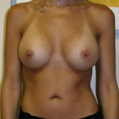 Breast Augmentation after 214432