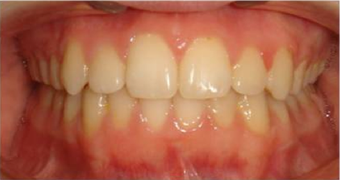 Braces in combination with orthognathic (jaw) surgery after 355264