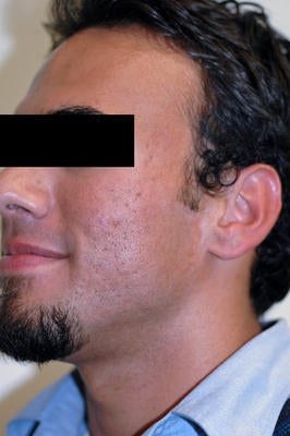 Laser Acne Scar Removal before 82965