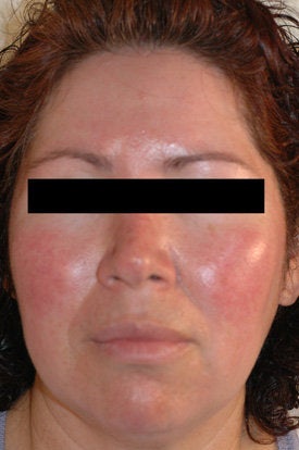 Laser Treatments for Rosacea before 106561