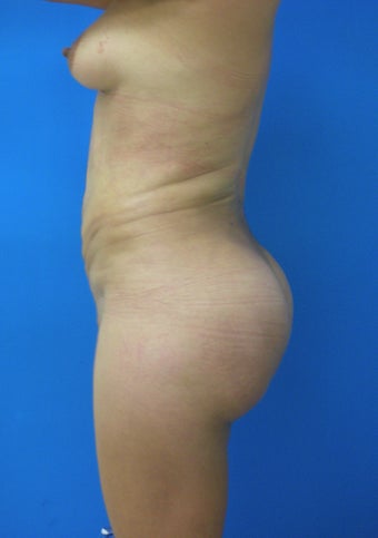Brazilian Butt lift 366996