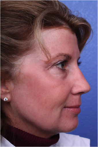 Laser Resurfacing after 408894