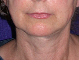 Necklift after 208445