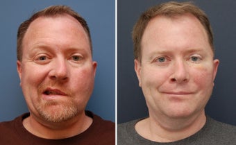 Facial Paralysis and Reconstruction before 346221