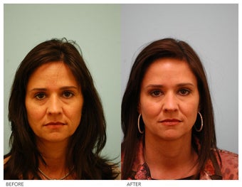 Botox, Fillers before 138527