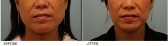 Botox Jaw (masseter) reduction before 396047