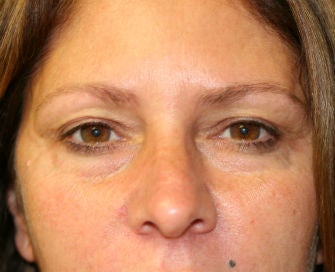 Lower eyelid blepharoplasty before 378916