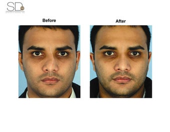 Revision Rhinoplasty before 100947